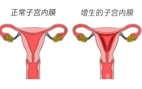 白带常规樱花草视频在线观看高清免费资源厂家解读子宫内膜增生是什么原因引起的